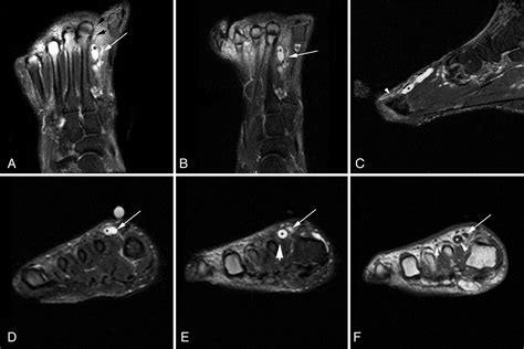 Magnetic Resonance Imaging Of A Deep Peroneal Intraneural Ganglion Cyst