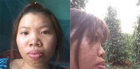 Bullied Vietnamese Girl Regains Self Confidence With Of Plastic