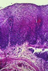 This condition occurs in the setting of patients with a weakened immune system who are susceptible. Esophagus, Gastric and Intestine Pathology Flashcards ...