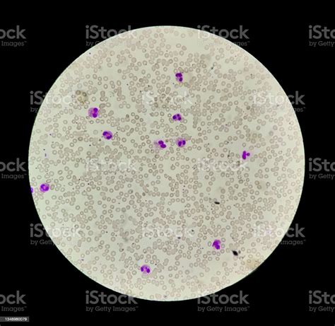 Eosinophilia Is A Condition In Which Eosinophils Count Abnormal High