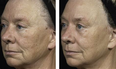 Fraxel Is The Original Fractional Laser Treatment That Works Below The