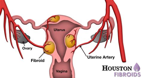 Benign fibromas (leiomyomas) can transform into leiomyosarcomas, malignant smooth muscle tumors in the uterus, in. This Study Proves UFE is as Effective as Hysterectomy for ...