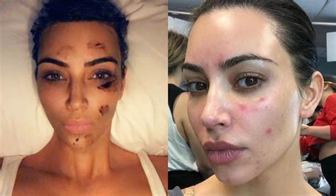 See The Terrible Skin Disease Kim Kardashian Is Battling With Photos Theinfong