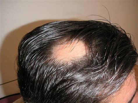 Alopecia areata is one type of hair loss that typically causes patches of baldness. Alopecia areata - Huidarts.com