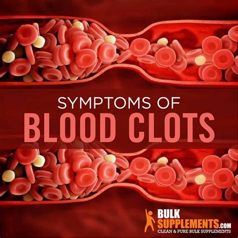 Blood Clots Symptoms Causes And Treatment Bulksupplements Health