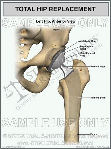 Pin By Alpha 59 On Products You Tagged In 2020 Total Hip Replacement