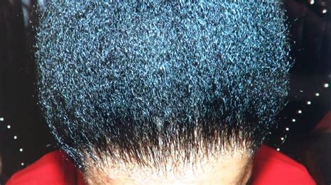 Maybe you would like to learn more about one of these? Black Woman Hair Transplant Excellent Result with Before ...