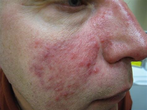 Facial Redness And Pimples Rosacea Acne And Rosacea Society