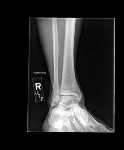 X Rays Of Ankle Bone Spurs Brianfukudaphotography