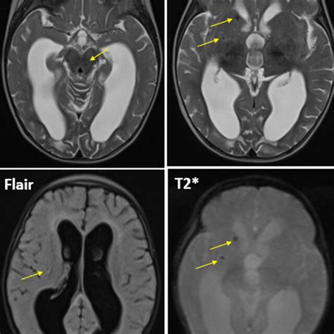Axial Sections Of A Brain Mri In T2 T2 Echo Gradient And Flair