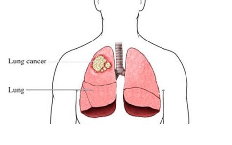 Do You Know These 14 Lung Cancer Symptoms Seereadshare