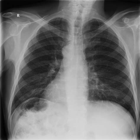 Chest X Ray Showed Dextrocardia And Right Sided Gastric Air Bubble