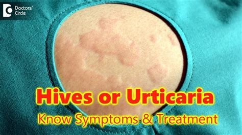 Hives Urticaria Causessymptomstreatment Skin Rash Allergy Dr