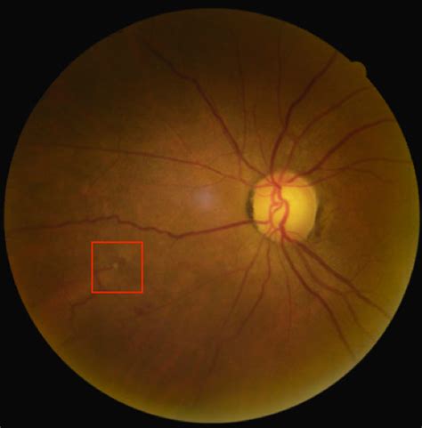 The manufacturing process, which includes being poured into a mold, finished, glazed, and then sent through a kiln, is pretty straightforward and fairly inexpensive. Retinal Imaging in Vitreous Hemorrhage Identification ...