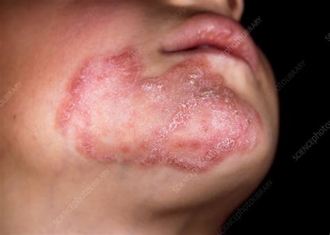 Fungal Skin Infections Face