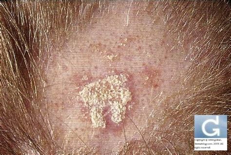 Global Dermatology Inflammatory Skin Diseases Of The Scalp