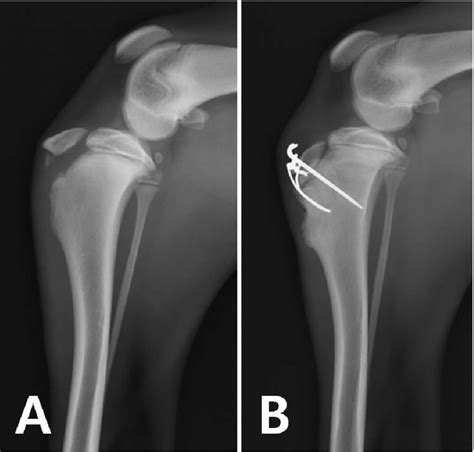 Radiographic View Of Stifle Joint Showing The Avulsion Fracture Of