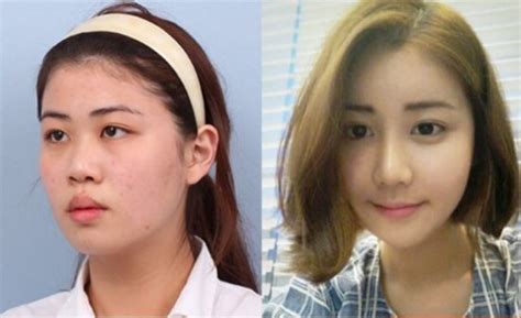 Crazy Before And After Photos Of South Korean Plastic Surgery