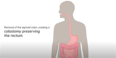 Understand Your Stoma Surgery Colostomy Coloplast Canada