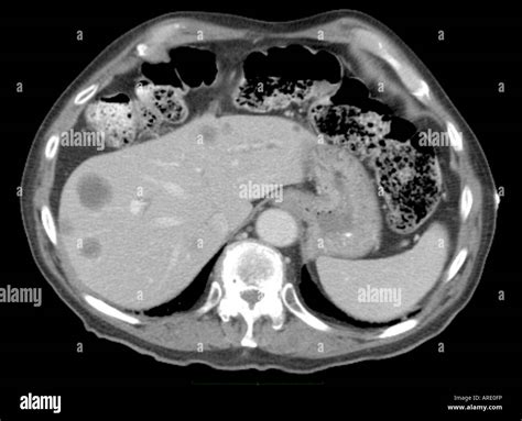 Ct Scan Image Of The Abdomen Showing Metastatic Lesions Of Prostate