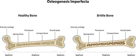 Osteogenesis Imperfecta And Scoliosis