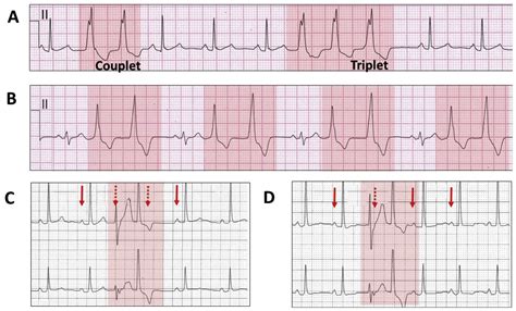 The Electrocardiographic Footprints Of Ventricular Ectopy Heart Lung