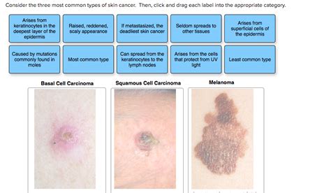Solved Consider The Three Most Common Types Of Skin Cancer Chegg Com