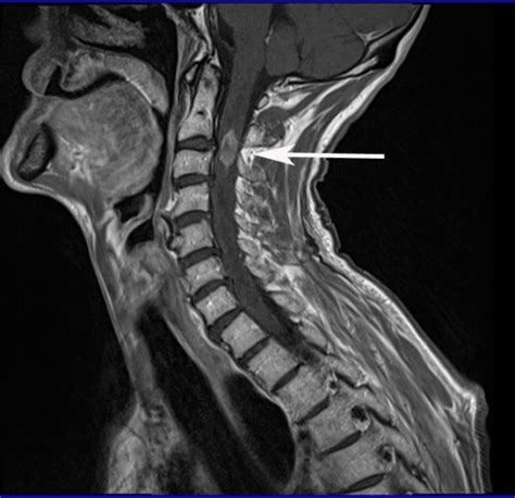 Sagittal T1 Weighted Mri Of His Cervical Spine Download Scientific