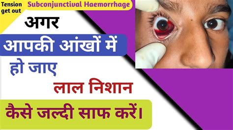 Red Spot In Eye Subconjunctival Hemorrhage Treatment Tension Get Out