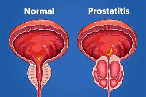 mes azul ¿qué es la prostatitis guia salud y vida