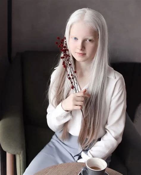 Heavenly Photoshoot Highlights The Unique Beauty Of A Girl With Albinism And Heterochromia