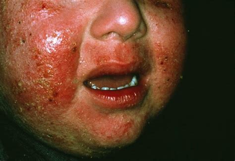 Severe Atopic Dermatitis May Benefit From Fezakinumab Dermatology Advisor