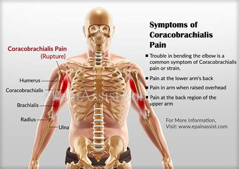 Coracobrachialis Pain Or Straincausessymptomstreatmentexercise