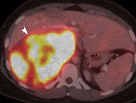 Adrenal Imaging A Three Category Approach To Managing Incidentalomas