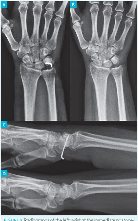 Figure 3 From Acute Pisiform Dislocation In Association With Terrible