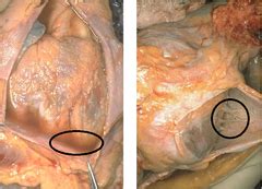 Circulating cardiac autoantibodies in dilated cardiomyopathy and myocarditis: Inflammatory Heart Diseases and Valvular Heart Diseases ...