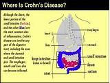 Marijuana And Crohn''s Disease Research Images