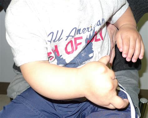 Congenital Hand And Arm Differences October 2012