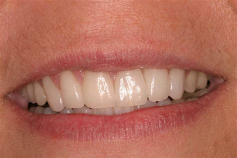 Natural Looking Dental Crowns In Troy Al