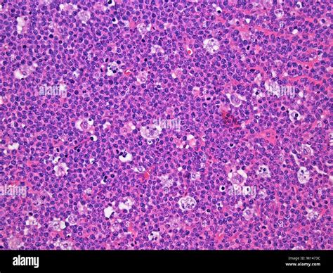 Burkitt Lymphoma In The Lymph Nodes Viewed At 300x Magnification With