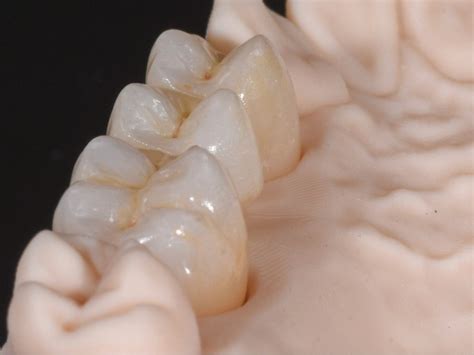 All Ceramic Restorations • Triad Dental Studio