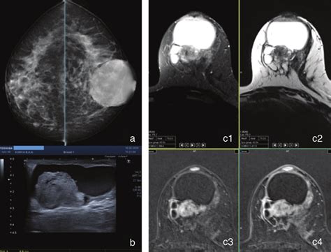 A 45 Year Old Female Patient Presenting Due To Stiffness In The Left