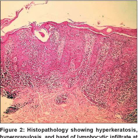 Figure 2 From Unilateral Blaschkoid Lichen Planus Semantic Scholar