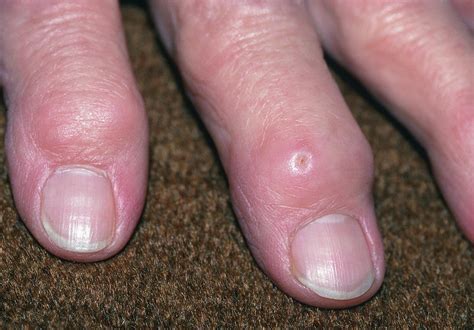 Deformed Fingers Due To Rheumatoid Arthritis Photograph By Science