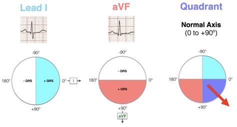 ECG Axis Interpretation LITFL ECG Library Basics