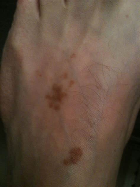 Mypension Document Brown Spots On Feet Type 2 Diabetes Nieuws