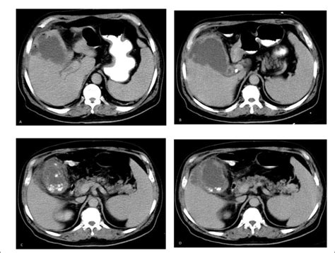 Axial Oral And Intravenous Contrast Enhanced Abdominal Computed