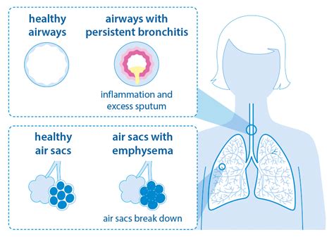 Today Is World Copd Day Chronic Obstructive Pulmonary Disease