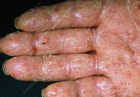 Contact Dermatitis Stock Image M1400271 Science Photo Library