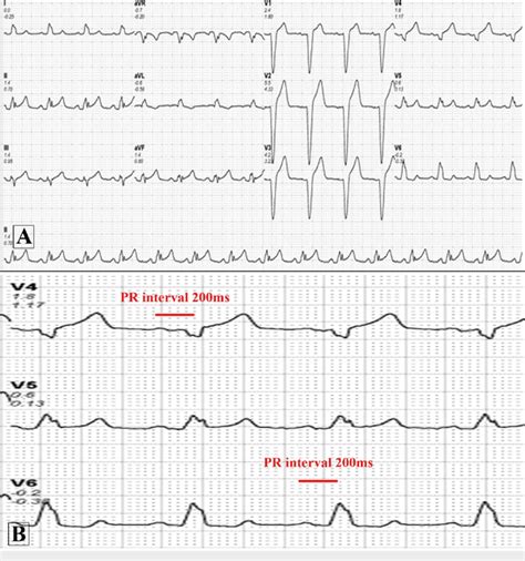 Baseline Electrocardiogram Of The Patient A Normal Sinus Rhythm At